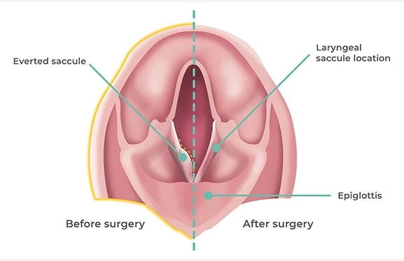 FIG 3 - Removing saccules in the larynx